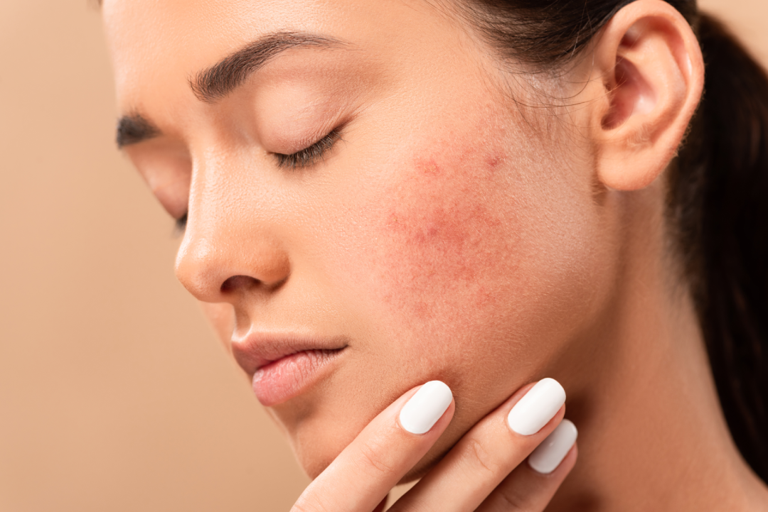 Close-up of a woman with red, inflamed acne on her cheek, highlighting the need for laser acne treatment.