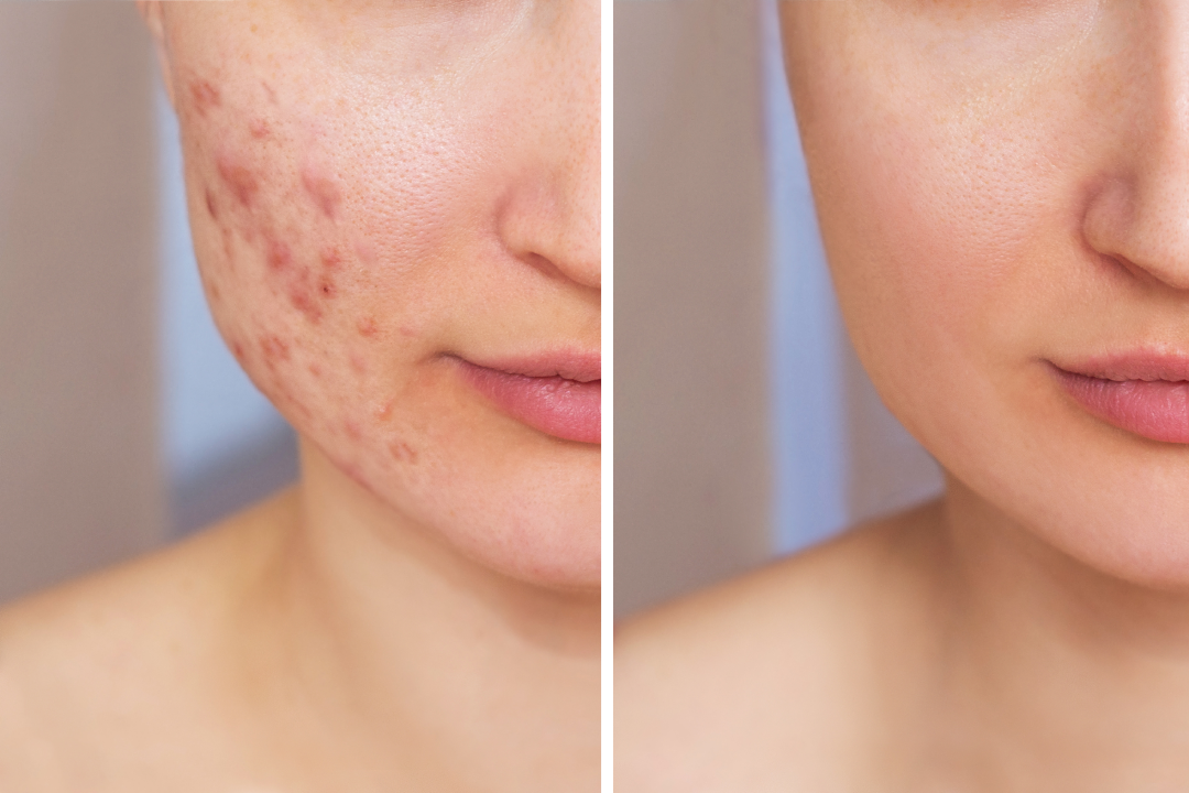 Before-and-after comparison showing significant improvement in acne scars and skin texture after laser acne treatment.