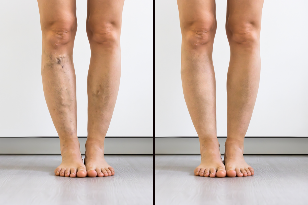 A before-and-after comparison showing the successful results of laser vein removal on leg