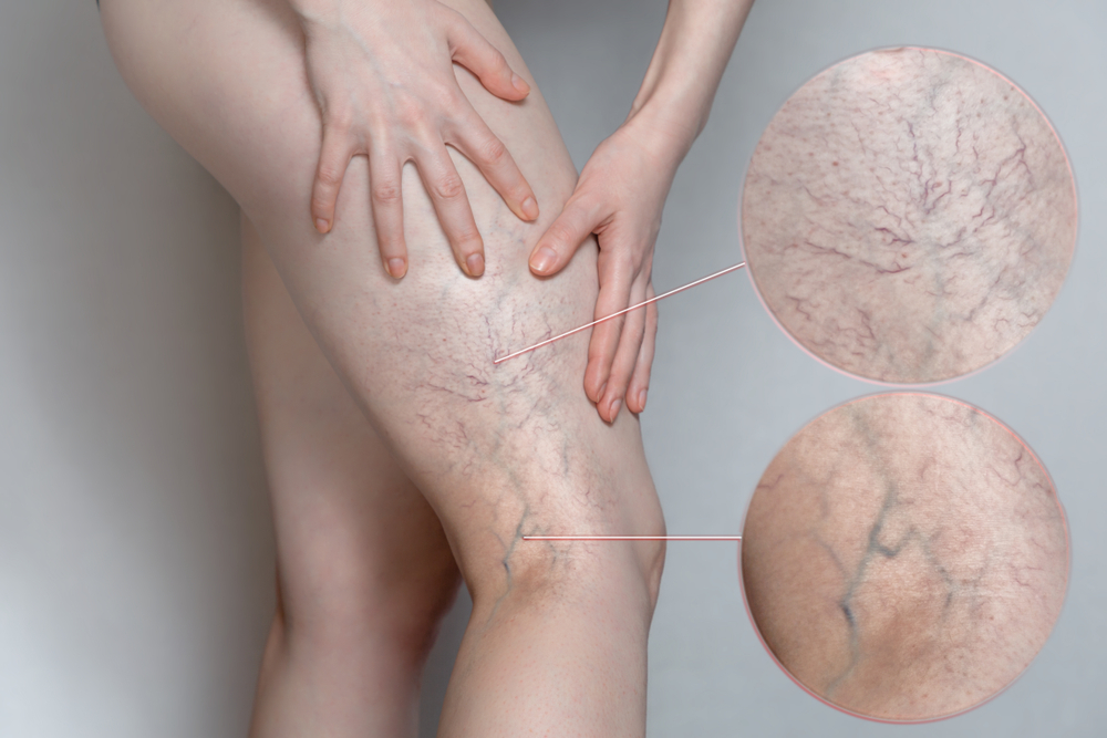 Close-up of veiny legs with detailed focus on areas needing laser vein removal treatment.