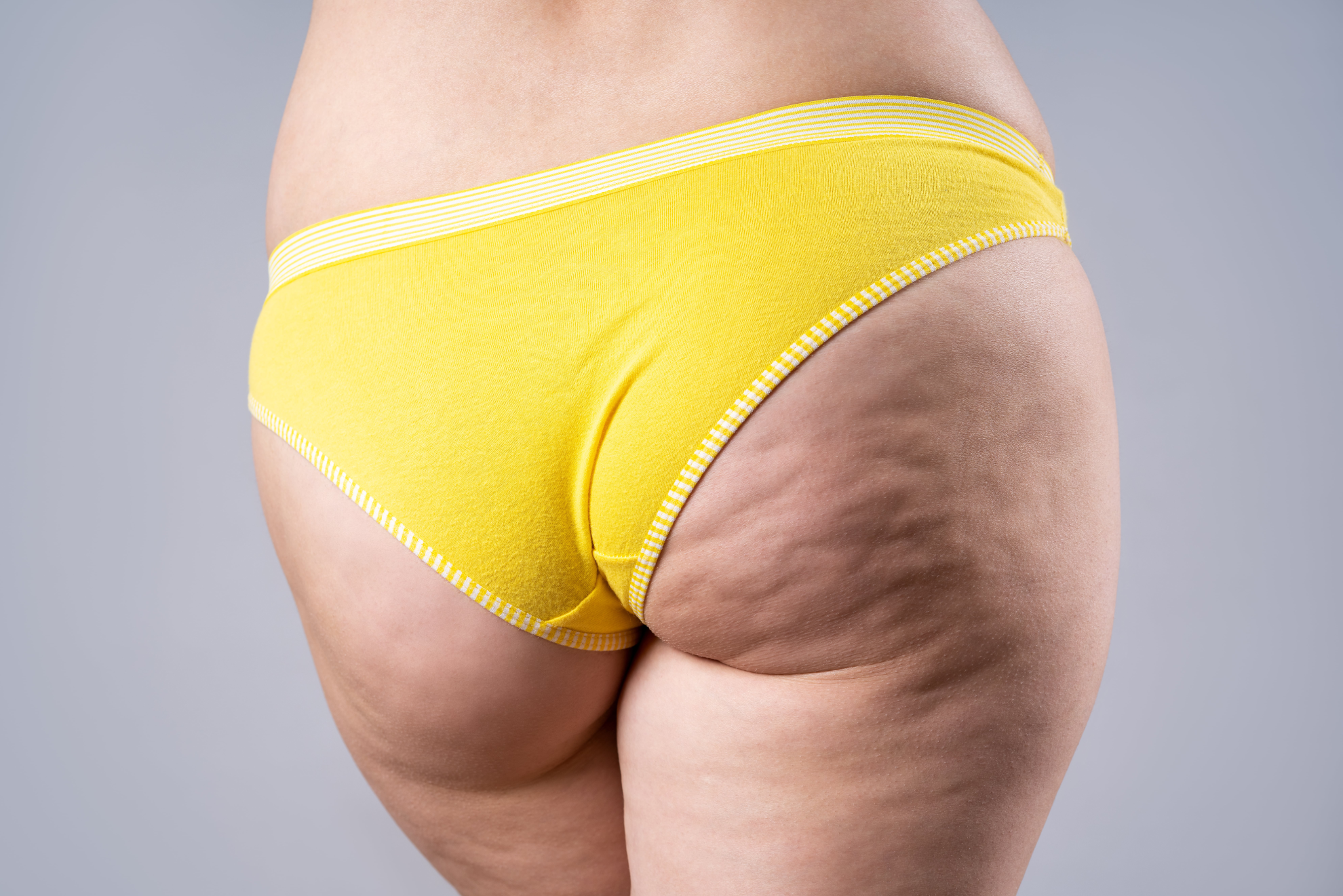 An example of cellulite reduction required for endospheres treatment. 