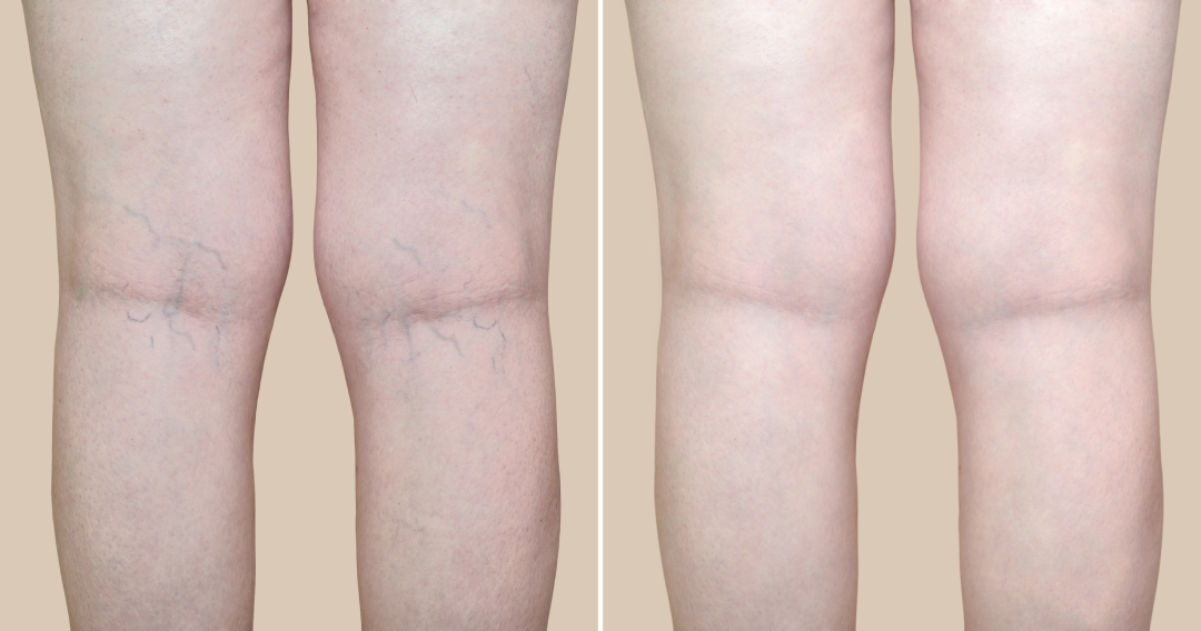 A before-and-after comparison of laser vein removal showing reduced visibility of spider veins.