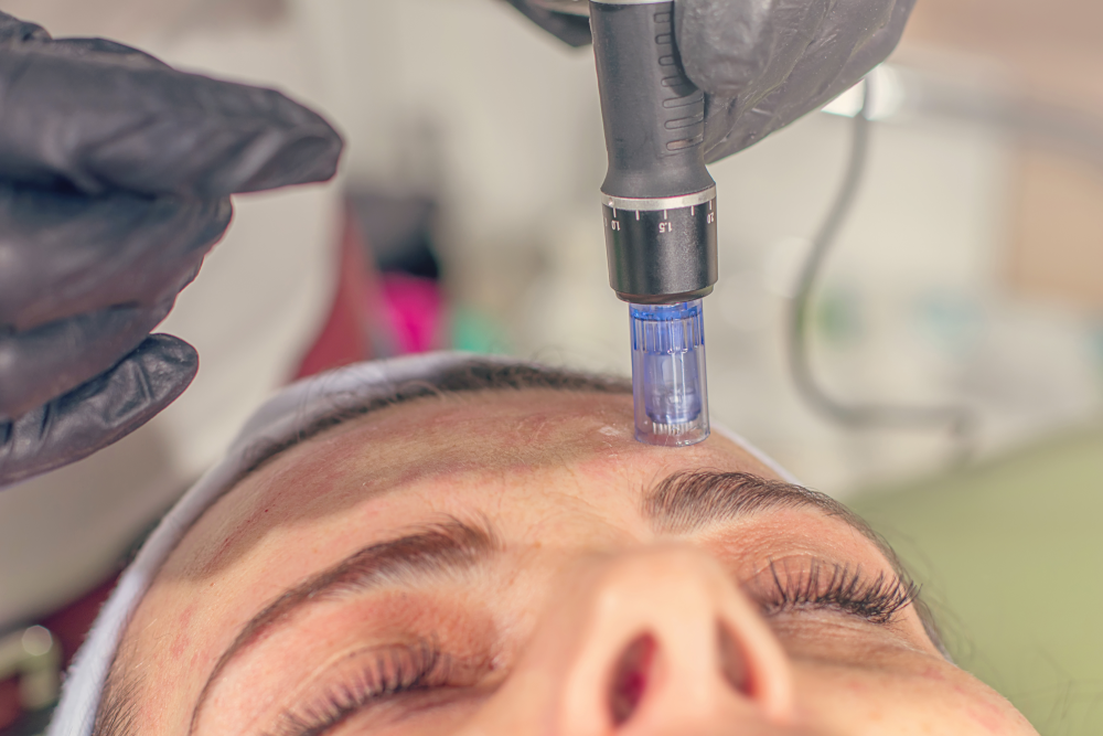 Microneedling device in action on forehead.