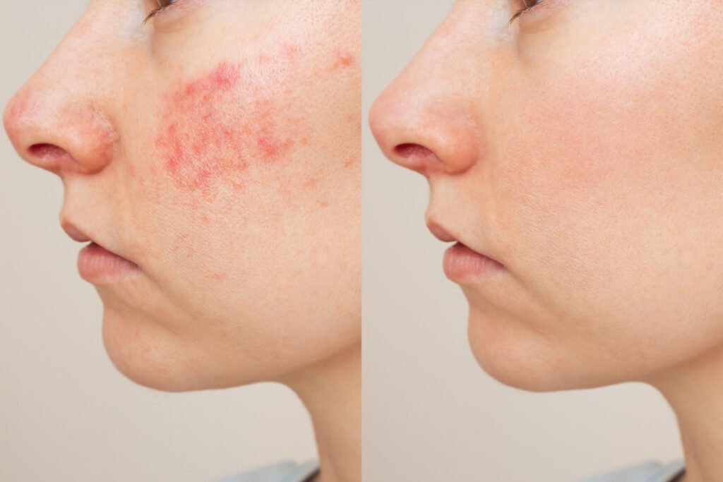 Left and right side-profile images showing visible differences in cheek redness and patchy discoloration.