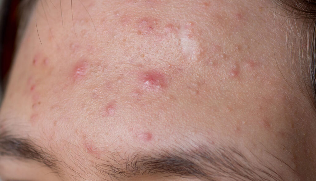 Close-up of a forehead with multiple red bumps, whiteheads, and small inflamed spots.