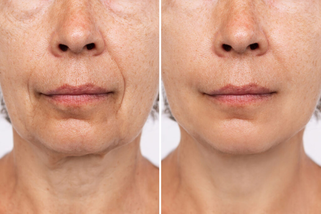 Before and after IPL treatment showing improved skin tone, reduced pigmentation, and smoother facial texture.